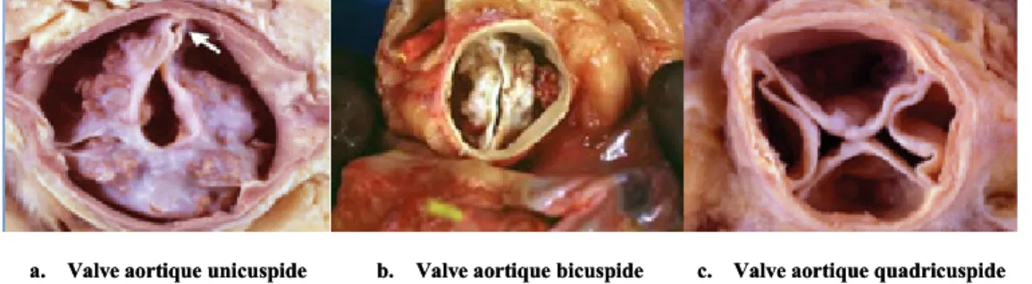 Figure 5: Variantes anatomopathologiques documentées de la valve aortique.  Adapté  de  Bennett  CJ  et al.,  2012  (a  et  c)  et  de  Heart  valve  surgery.com   (www.heart-valve-surgery.com )  (b)