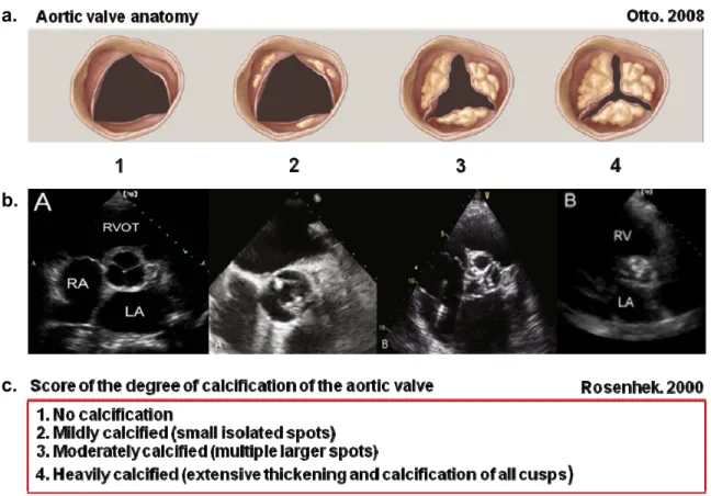 Figure 9: Classification du niveau de calcification valvulaire aortique proposé par  Rosenhek et al