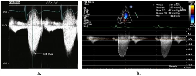Figure 10: Mesures par Doppler de la vitesse transvalvulaire aortique maximale (a et b)  et calcul des gradients transvalvulaires aortiques maximal et moyen (b)