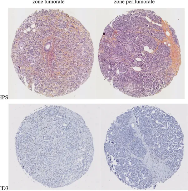 Figure 4 - Biopsies représentatives  prises en zone tumorale (colonne de gauche)  et en  zone  péritumorale  en  (colonne  de  droite)