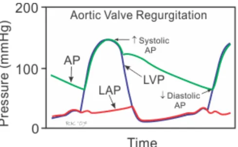Figure 10: Variation des pressions dans le ventricule gauche, l’oreillette gauche et l’aorte durant  le cycle cardiaque en présence d’une régurgitation aortique