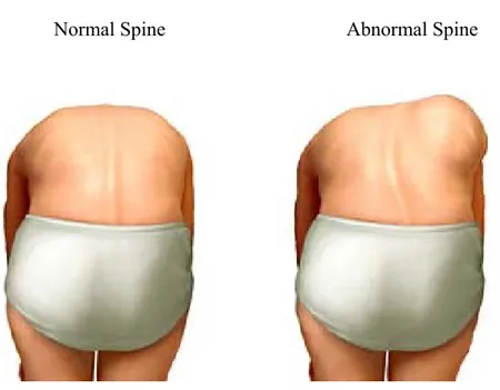 Figure 1: Adam's forward bend test, used for the evaluation of the spinal deformity  (adapted from Reamy, et al)
