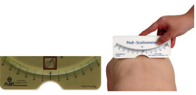 Figure 2: Scoliometer measures the spinal deformity. It is a simple instrument  for the  detection the spinal curvature (adapted from Franko, et al)