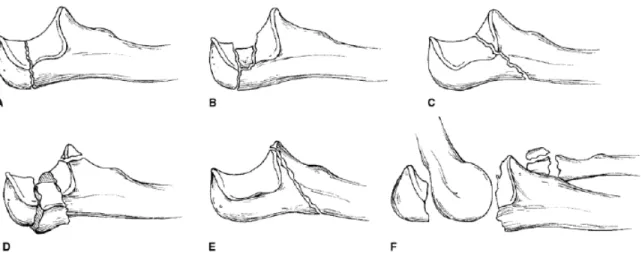 Figure  2-  Classification  de  Schatzker  des  fractures  de  l’olécrâne.    A,  Type  A,  fracture  simple transverse