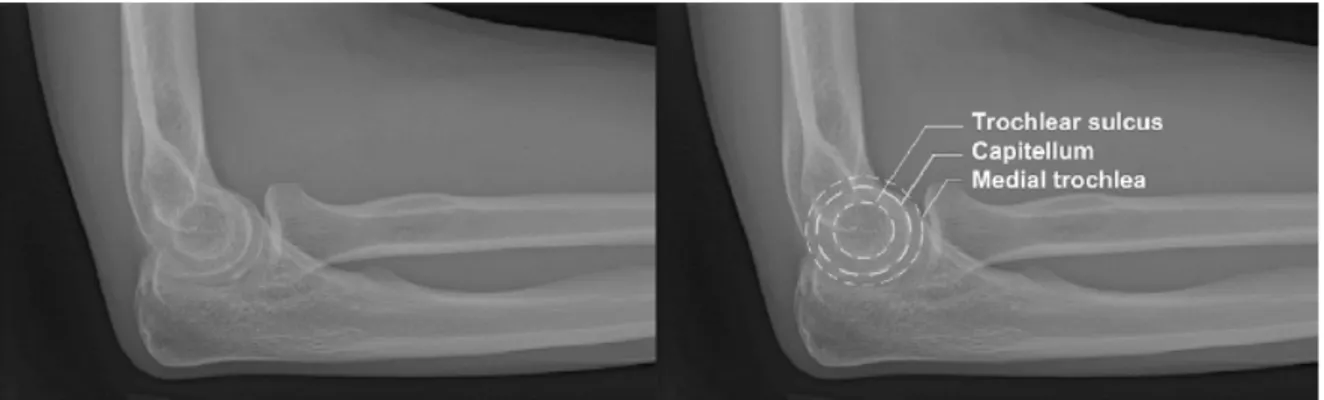 Figure  4-  Radiographies  latérales  acceptables  du  coude  démontrant  l’identification  des  3  arcs concentriques: le sillon trochléaire, le capitellum et la trochlée médiale