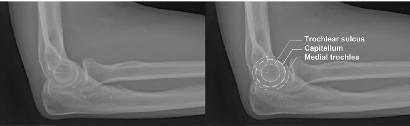Figure  1:  An  example  of  an  acceptable  lateral  radiograph  with  identification  of  the  3  concentric arcs: the trochlear sulcus, the capitellum, and the medial trochlea