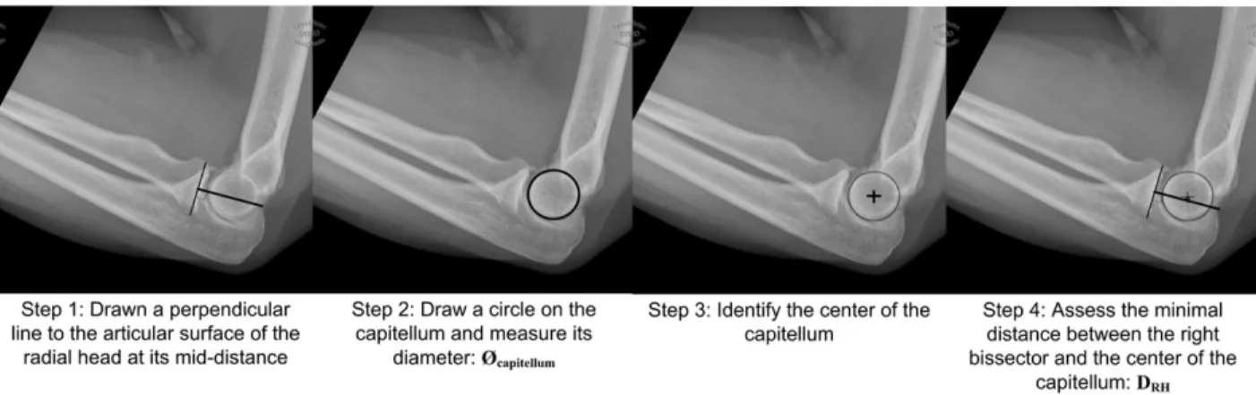 Figure 2 The radiocapitellar ratio (RCR) measurement technique is performed in 4 steps: (1) a  line is drawn perpendicular to the articular surface of the radial head at its middle distance; (2)  the articular radius of curvature of the capitellum is used 