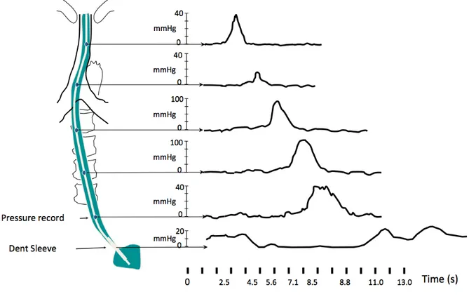 Figure 2.    Example of a manometric study with a conventional water-perfused manometry