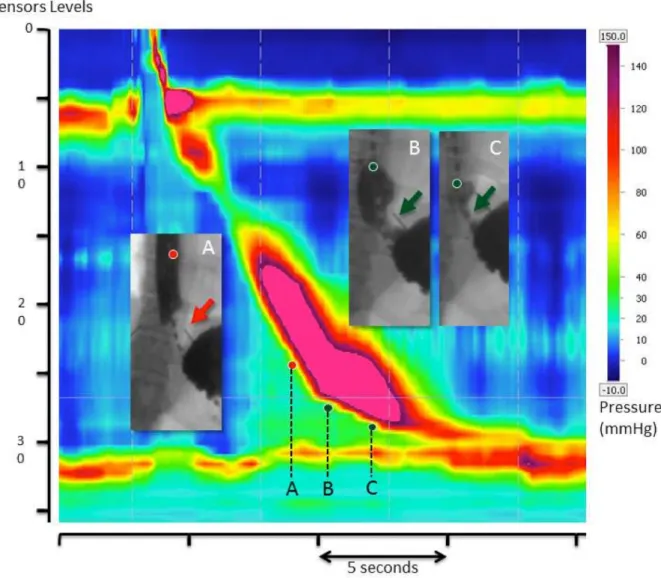Figure 7.    EPT of a swallow from an asymptomatic patient with a standard HRM assembly