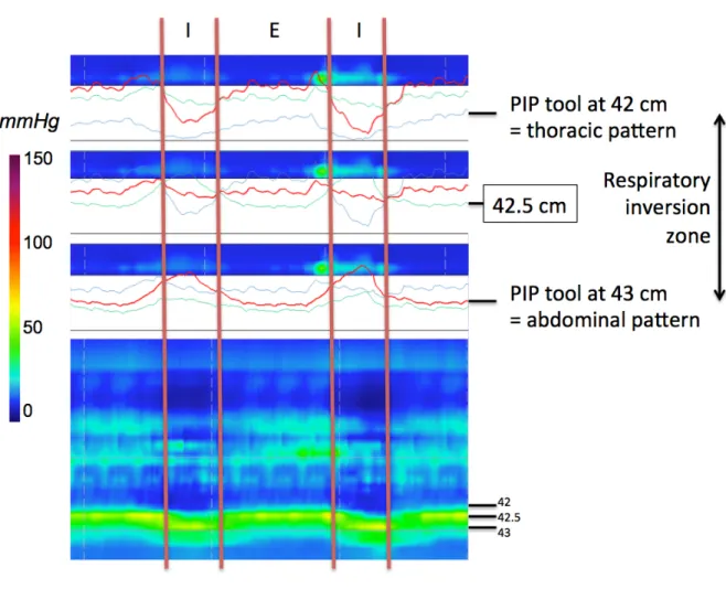 Figure 9.    Characteristics of the RIP, using the 3D-HRM assembly. 