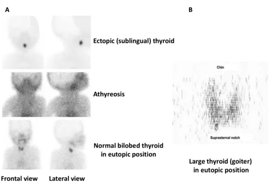 Figure  8:  Thyroid  scintigraphy.  8A:  Newborn  thyroid  scintigraphy,  using  99m Tc,  showing  examples of TD (modified from Van Vliet, 2003)