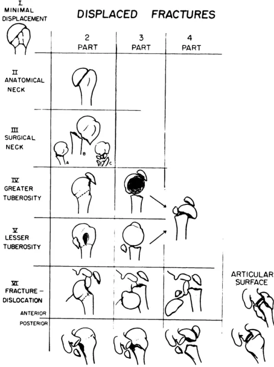 Figure 5 = Neer’s 4-Part Classification of Proximal Humerus Fractures [reproduced  with permission, Neer 1970] 