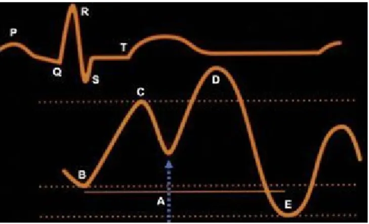 Figure 7: Illustration des effets d'un BIA sur la pression artérielle d'un patient. Le BIA  augmente la pression diastolique et diminue la post charge