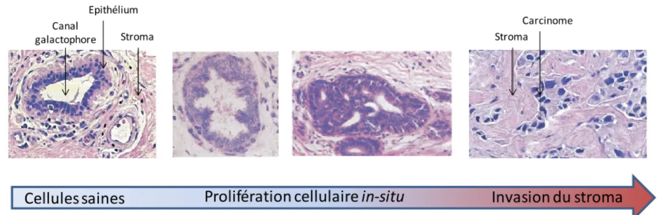 Figure 2.3 Formation progressive de la tumeur: de gauche à droite, les cellules épithéliales  recouvrent  la  membrane  basale  du  canal  galactophore
