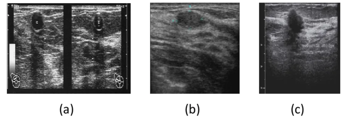 Figure  2.5  Exemples  d’images  ultrasonores  obtenues  dans  les  cas  (a)  d’un  kyste,  (b)  d’un  fibroadénome  et  (c)  d’un  carcinome