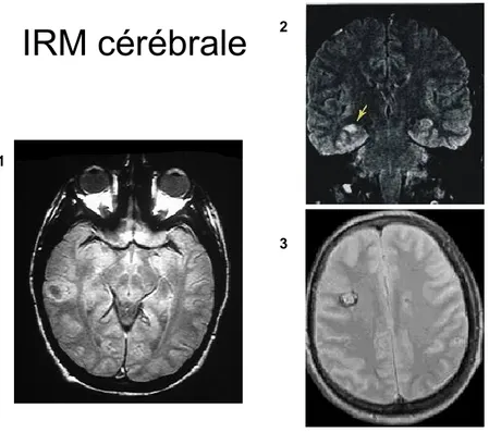 Figure  5.  Images  de  résonance  magnétique  cérébrale  mettant  en  évidence  diverses  lésions  épileptogènes: 1- gliome  2- sclérose hippocampique 3- angiome caverneux