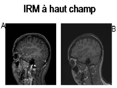 Figure 7. a) Image obtenue à partir d’une IRM 1,5T; b) Image obtenue à partir d’une IRM 3T