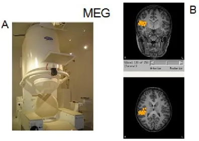 Figure 9. a) Appareil de magnétoencéphalographie installée dans une chambre blindée; b) localisation  de sources des décharges épileptiques enregistrées déterminée par la méthode de dipôle équivalent de  courant