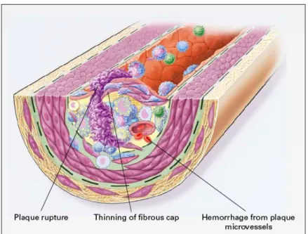 Figure 8. Rupture d’athéromes instable. Tirée de Ross et al. 1999 (71). 