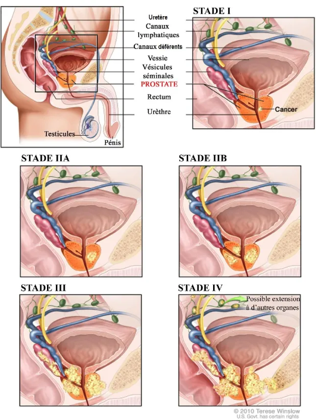 Figure 6 : Illustration des stades de progression du cancer de la prostate. Traduit par Ingrid  Labouba