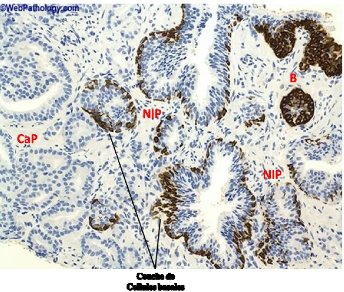 Figure  8  :  Couche  basale  épithéliale  prostatique  dans  la  néoplasie  intra-épithéliale  prostatique et le cancer de la prostate
