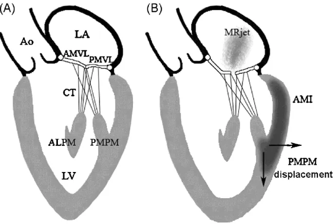 Figure 2  Mécanisme de l’insuffisance mitrale ischémique chronique  