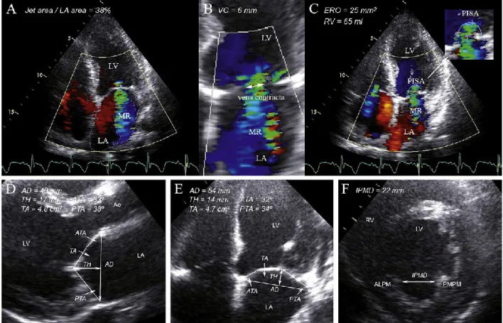 Figure 4  Évaluation échocardiographique de l’insuffisance mitrale ischémique 