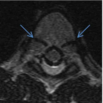 Figure	
   1	
  :	
   Coupe	
   T2	
   de	
   résonnance	
   magnétique	
   avec	
   les	
   cartilages	
   neurocentraux	
   ouverts	
  (flèches	
  bleues).	
  