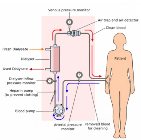 Figure 2 : L'hémodialyse 