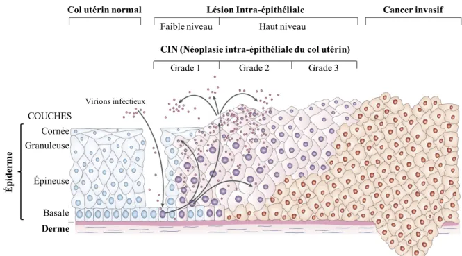 Figure 1.3. Progression d’une lésion bénigne à maligne causée par l’infection au VPH. 