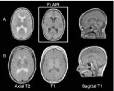 Figure 2: IRM de patients atteints du syndrome TACH. A) IRM du patient 7 (âgé de 11 ans, 