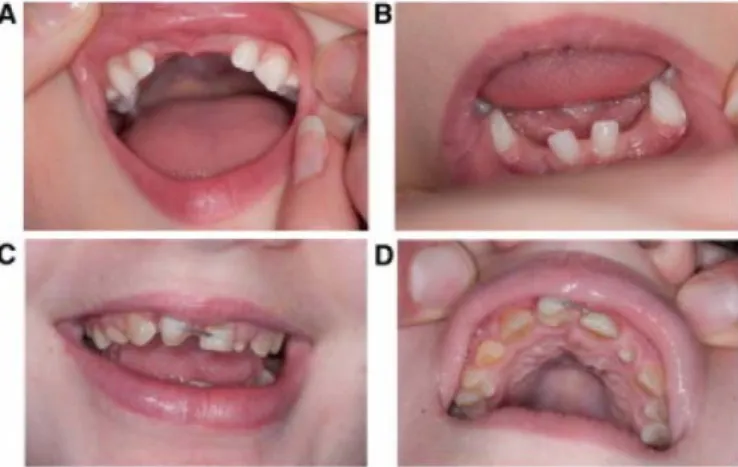 Figure 4: Teeth abnormalities. A) andB) demonstrate the teeth abnormalities seen in case 1: 