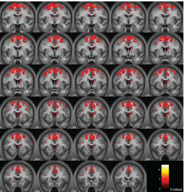 Figure	
  II.2.2.2c.	
  From	
  Teki	
  et	
  al.	
  (2011).	
  BOLD	
  activations	
  for	
  relative,	
  beat-­‐based	
  timing	
  (regular	
  vs	
   irregular)	
  are	
  shown	
  in	
  a	
  series	
  of	
  coronal	
  sections.	
  Significant	
  activations	
  were	
  found	
  in	
  the	
  striatum,	
   thalamus,	
  premotor	
  cortex,	
  SMA,	
  and	
  prefrontal	
  areas	
  including	
  the	
  dorsolateral	
  prefrontal	
  cortex	
  at	
   a	
  threshold	
  of	
  p=0.001	
  (uncorrected).	
  The	
  strength	
  of	
  activations	
  (t-­‐value)	
  is	
  graded	
  according	
  to	
  the	
   color	
  scheme	
  at	
  the	
  bottom	
  right.	
  