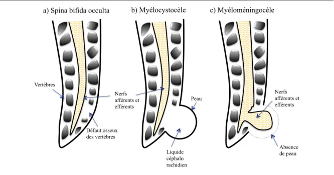 Figure  4.  Vue  latérale  des  différents  types  de  spina  bifida.  a)  La  spina  bifida  occulta;  b)  La 