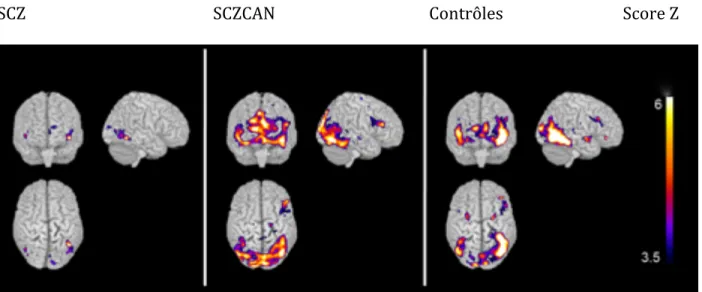 Figure	
   3.	
   Signal	
   BOLD	
   (Blood	
   oxygenation	
   level	
   dependant)	
   durant	
   la	
   reconnaissance	
   des	
   images	
  à	
  valence	
  négative	
  dans	
  les	
  trois	
  groupes.	
  	
  