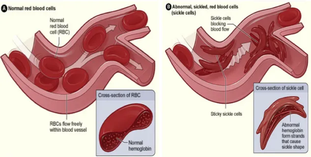 Figure 1.7. Altération du flux sanguin par les érythrocytes falciformes  