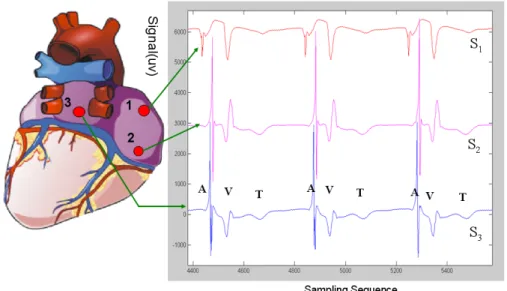 Figure 2. 1 Posterior view of the heart showing the 3 electrodes sutured to the right (S 1 , 