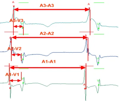 Figure 2. 19 AA intervals of two consecutive beats with the same order of atrial firing 