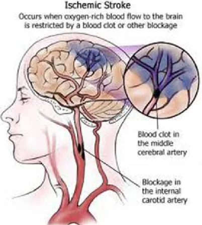 Figure  1.5:  Ischemic  brain  tissue  downstream  of  arterial  occlusion.  Adapted  from: 