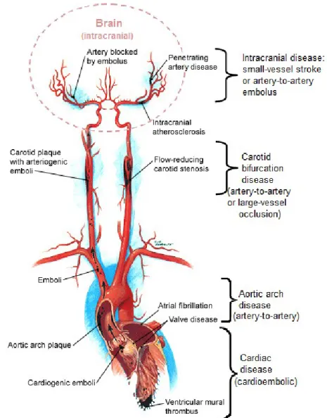Figure 1.6: Mechanisms of ischemic stroke. Adapted and modified from [9]. 