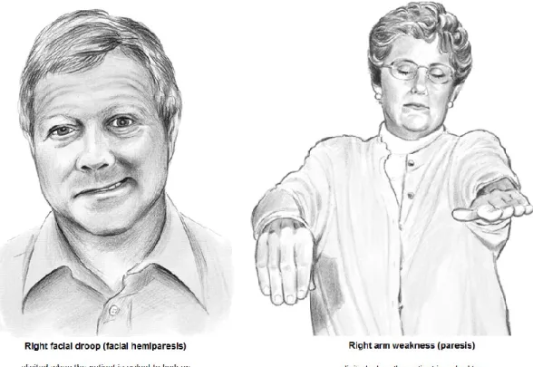 Figure  1.8:  Signs  of  left  middle  cerebral  artery  (MCA)  stroke.  Right  facial  and  upper  limb weakness