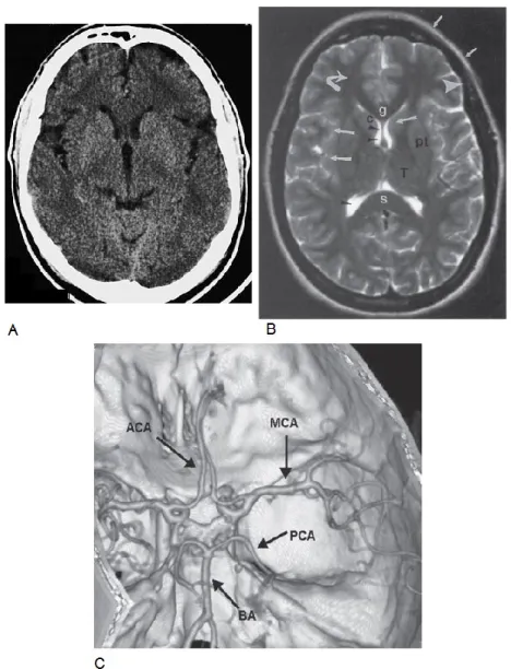 Figure 1.9: Normal brain images. A. Axial CT scan of the brain. Adapted from: Moeller  TB,  Reif  E