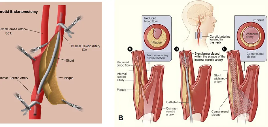 Figure 1.15: A. Carotid Endarterectomy (CEA) procedure. Adapted and modified from: 