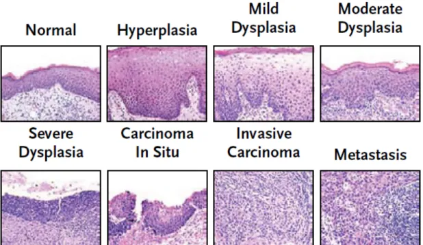 Figure 3 : Évolution histologique d’un carcinome épidermoïde. Tiré de : Haddad, R. I. and   D