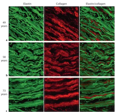 Fig.  4.    Near-infrared  multiphoton  LSM.  Elastin  autofluorescence  signals  (green)  and SHG-signals of collagen (red) are  de-picted for aortic cross sections  (circumfer-ential view) of 49- (  a  ), 58- (  b  ) and 73- (  c  )  year-old  patients