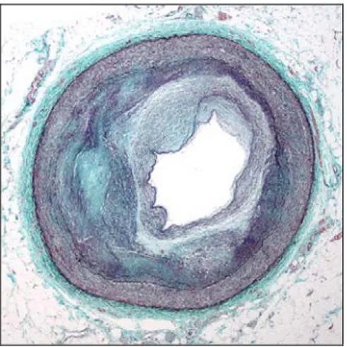 Figure 5 - Artère coronaire distale avec athérosclérose complexe et diminution de la  lumière (71) 