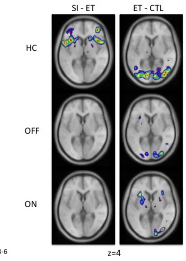 Figure 22: Peaks at the intersection of the VLPFC and the insula in healthy controls  and patients 