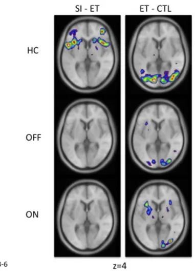 Figure 22: Peaks at the intersection of the VLPFC and the insula in healthy controls  and patients 
