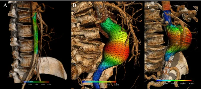 Figure 1.1: Qualitative description of normal aorta and AAA shapes.   ( A ) Normal aorta