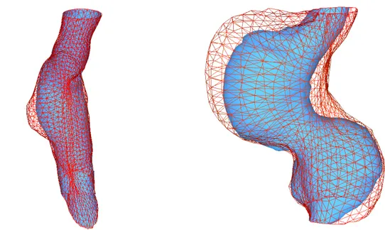 Figure 1.2: Discrepancies between diameter and volume growth in two AAAs.  